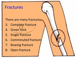 Fractures  There are many fractures. Complete fracture Green stick Single fracture Comminuted fracture  Bowing fracture Open fracture 
