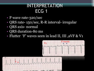 ECG: Narrow Complex Tachycardia | PPT