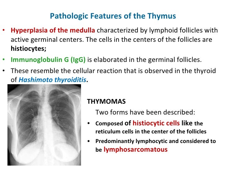 Thymus Gland And Myasthenia Gravis
