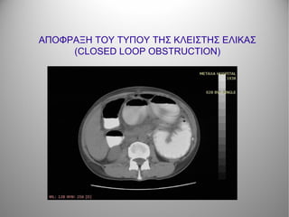 ΑΠΟΦΡΑΞΗ ΤΟΥ ΤΥΠΟΥ ΤΗΣ ΚΛΕΙΣΤΗΣ ΕΛΙΚΑΣ
(CLOSED LOOP OBSTRUCTION)
 