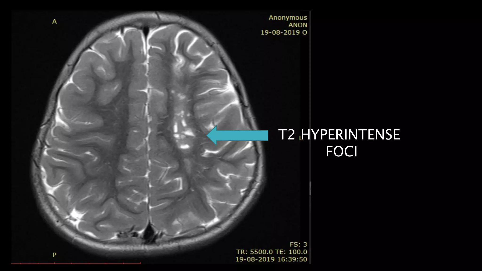 T2 HYPERINTENSE
FOCI
 