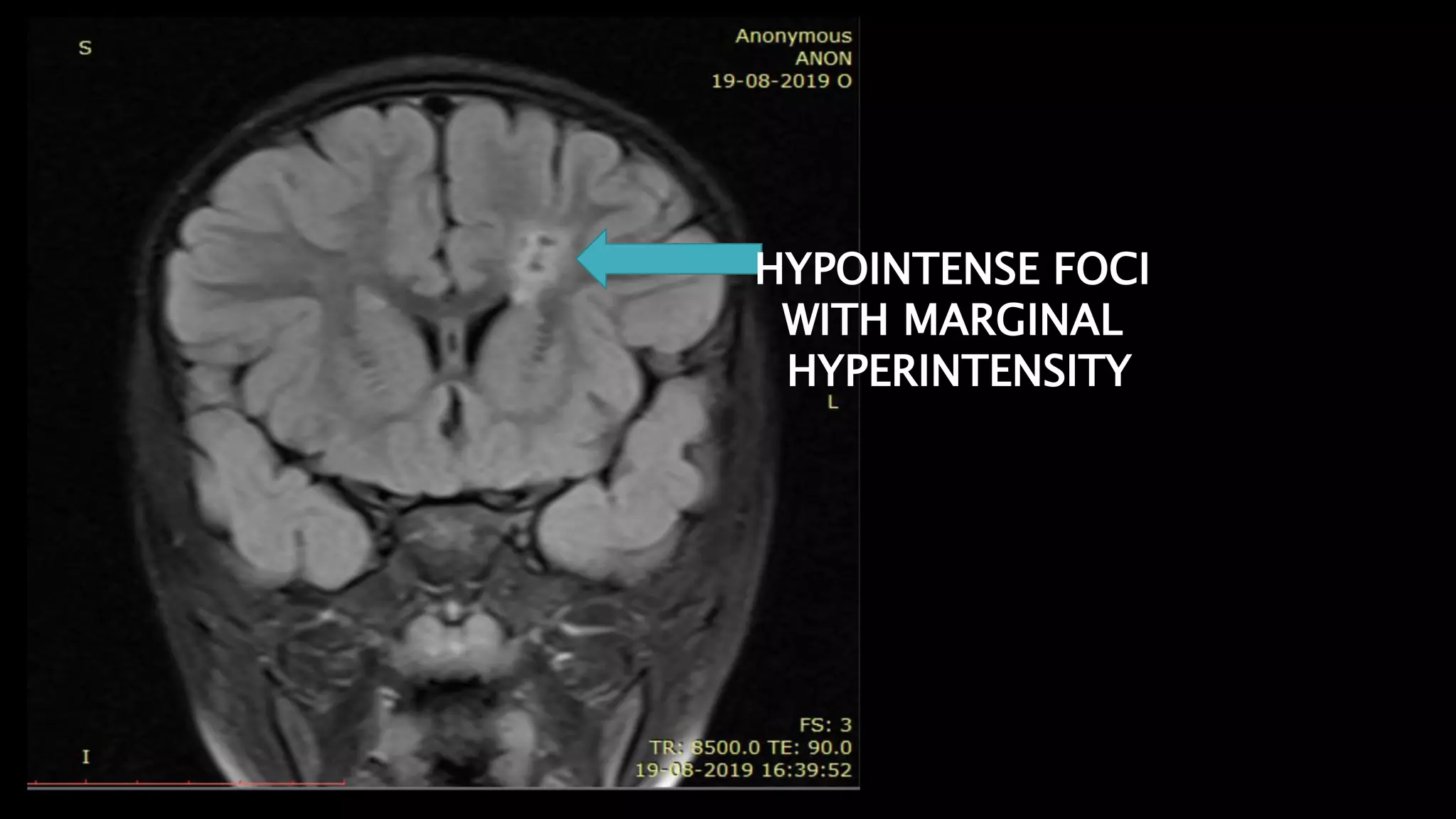 HYPOINTENSE FOCI
WITH MARGINAL
HYPERINTENSITY
 