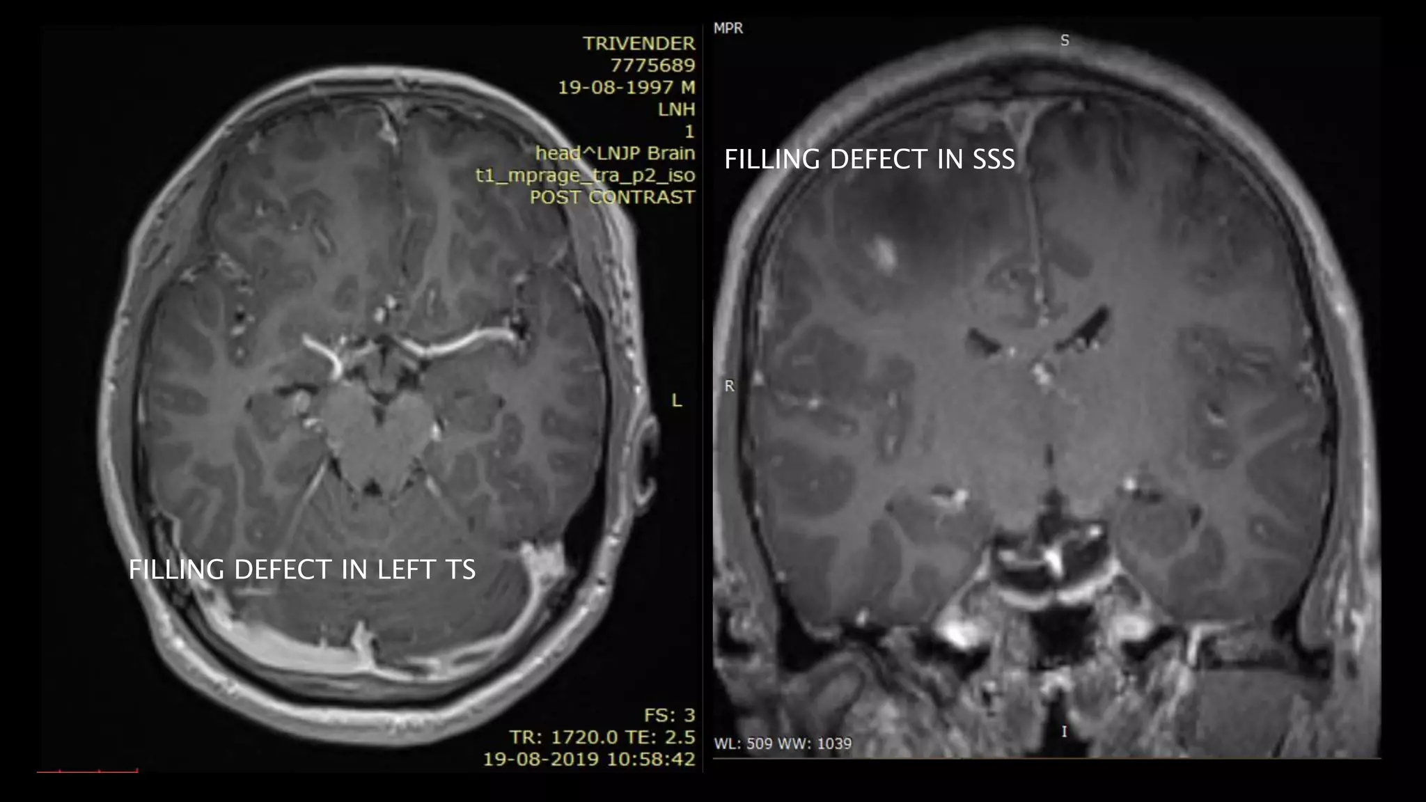 FILLING DEFECT IN SSS
FILLING DEFECT IN LEFT TS
 