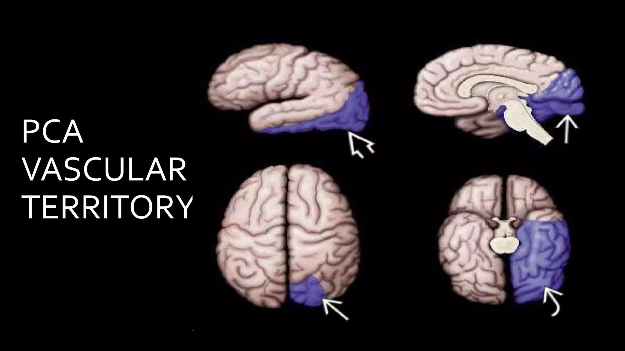 PCA
VASCULAR
TERRITORY
 