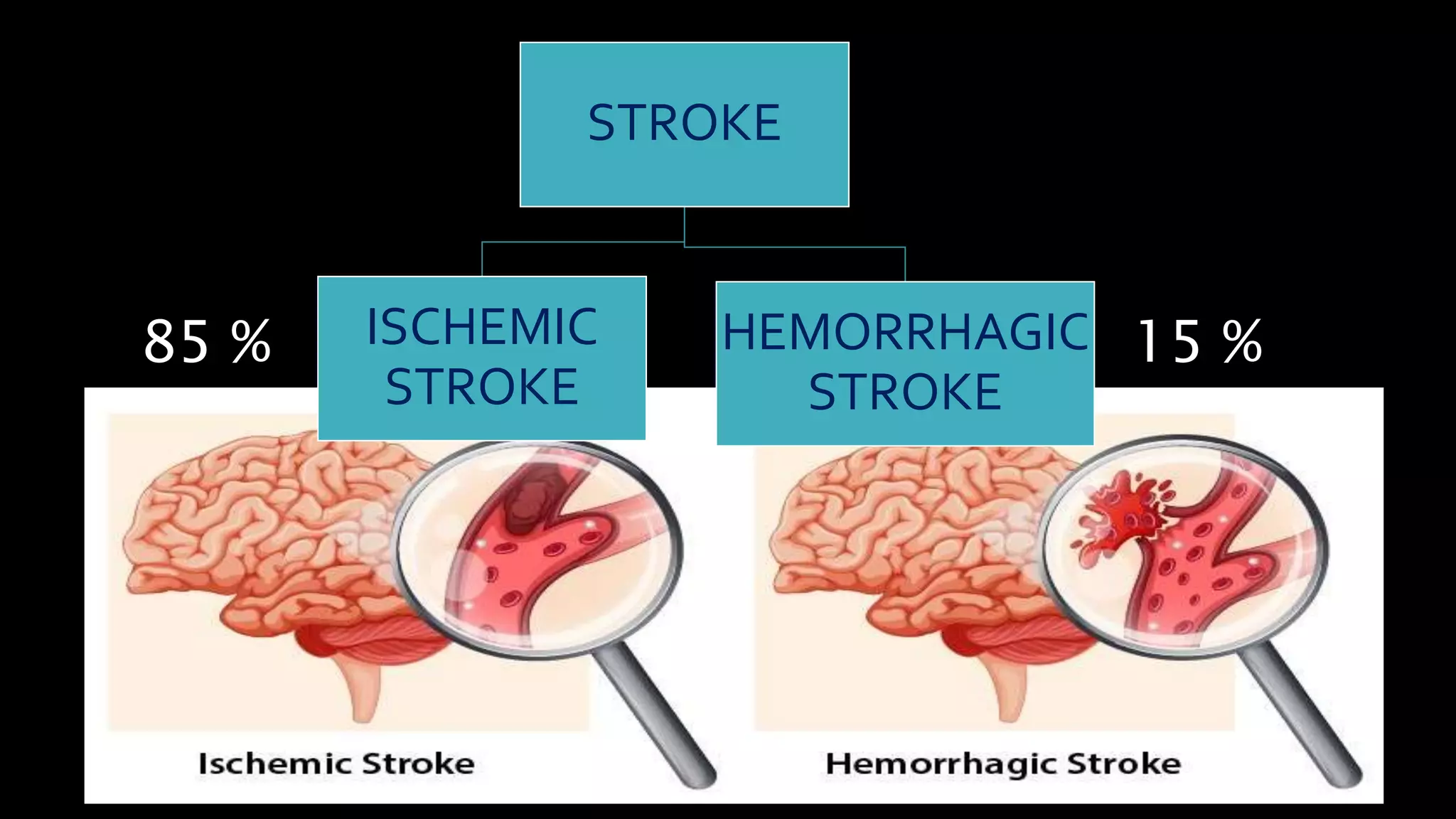 STROKE
HEMORRHAGIC
STROKE
ISCHEMIC
STROKE
85 % 15 %
 