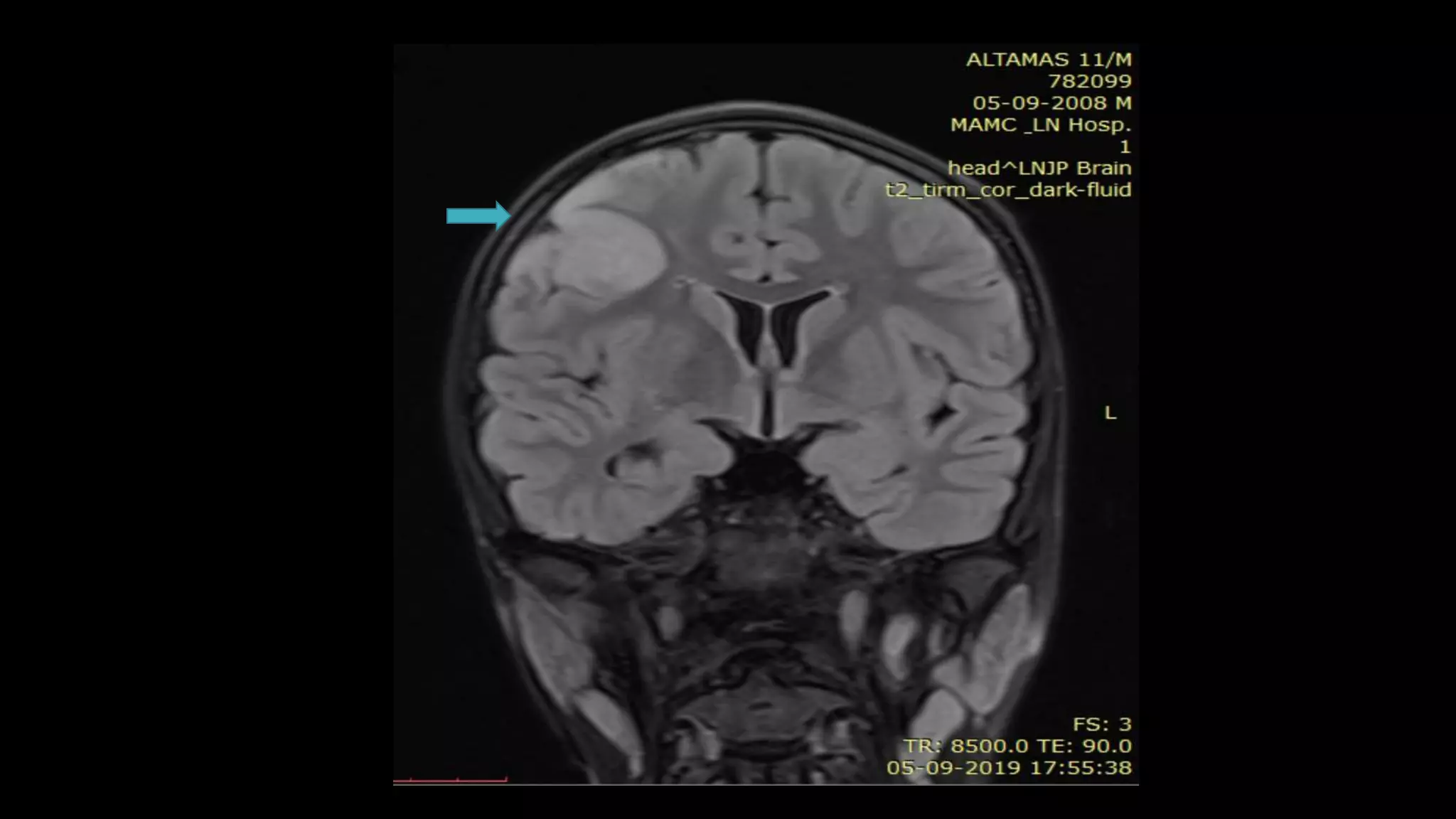 FLAIR
HYPERINTENSITI
ES
 