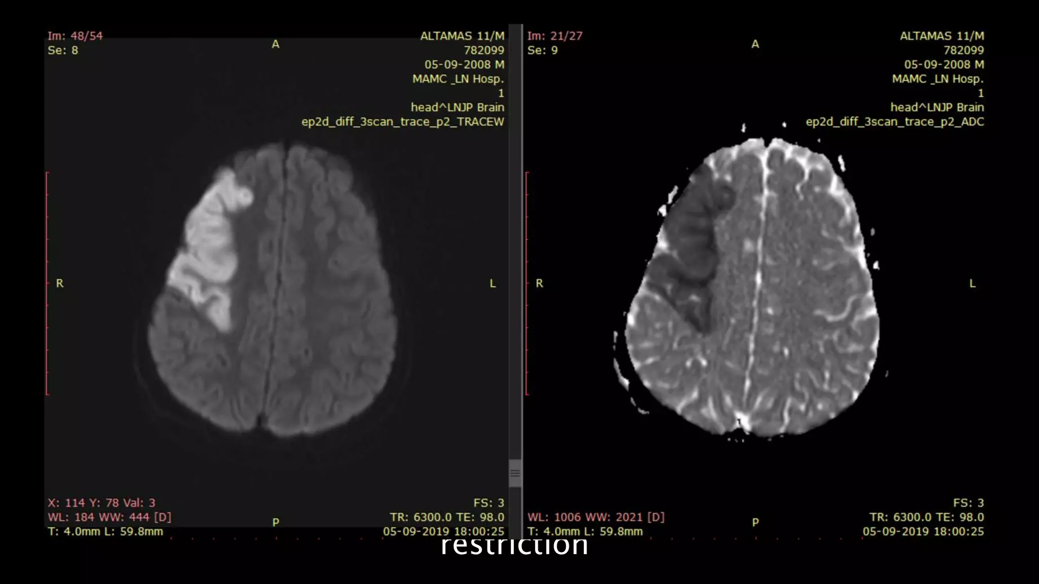 Head of right
caudate
nucleus and
lentiform
nucleus show
diffusion
restriction
 