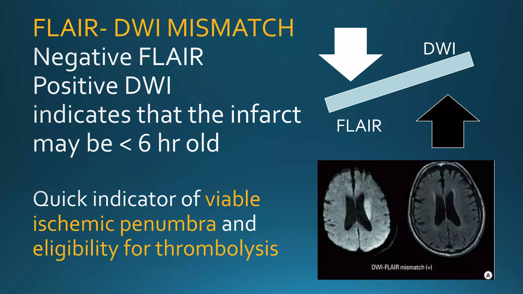 FLAIR- DWI MISMATCH
viable
ischemic penumbra
eligibility for thrombolysis
DWI
FLAIR
 