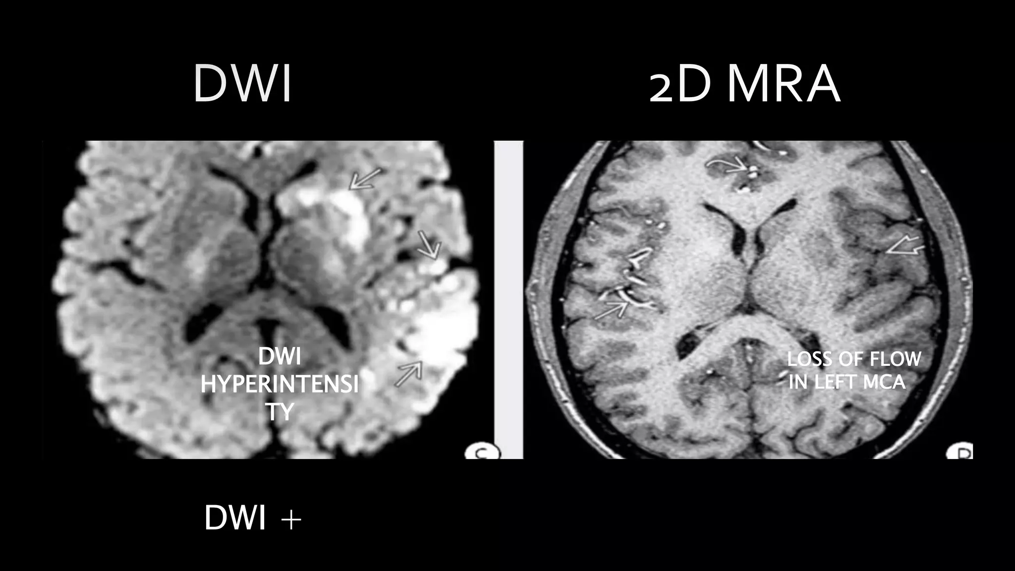 DWI +
DWI
HYPERINTENSI
TY
LOSS OF FLOW
IN LEFT MCA
 