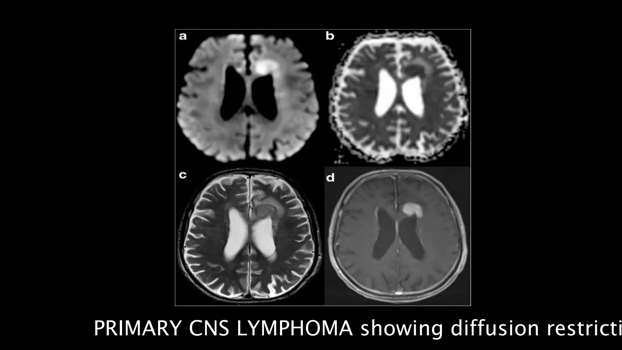 PRIMARY CNS LYMPHOMA showing diffusion restricti
 