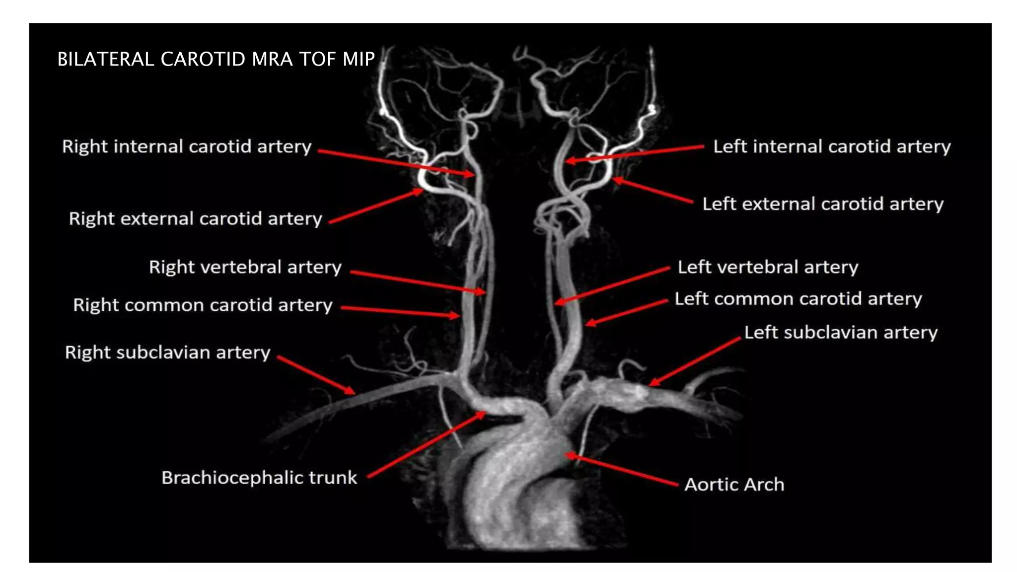 BILATERAL CAROTID MRA TOF MIP
 