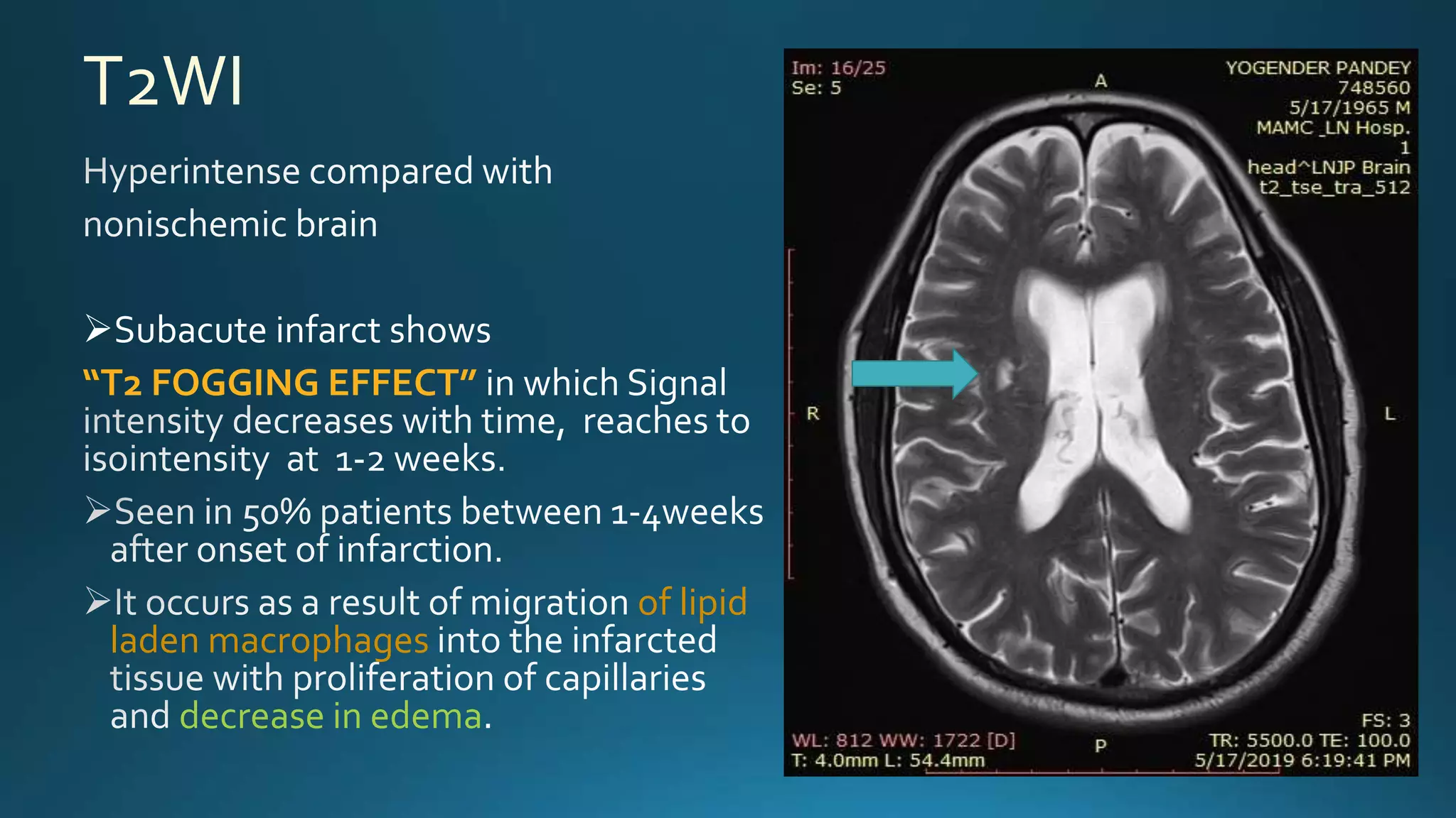 T2WI
Subacute infarct shows
“T2 FOGGING EFFECT” in which
of lipid
laden macrophages
decrease in edema
 