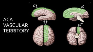 ACA
VASCULAR
TERRITORY
 