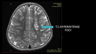 T2 HYPERINTENSE
FOCI
 