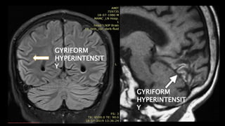 GYRIFORM
HYPERINTENSIT
Y
GYRIFORM
HYPERINTENSIT
Y
 