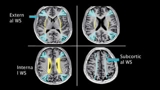 Extern
al WS
Subcortic
al WS
Interna
l WS
 