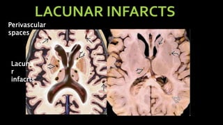 LACUNAR INFARCTS
Perivascular
spaces
Lacuna
r
infacrts
 
