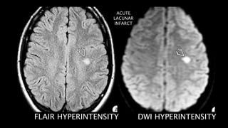FLAIR HYPERINTENSITY DWI HYPERINTENSITY
ACUTE
LACUNAR
INFARCT
 