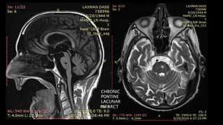 CHRONIC
PONTINE
LACUNAR
INFARCT
 
