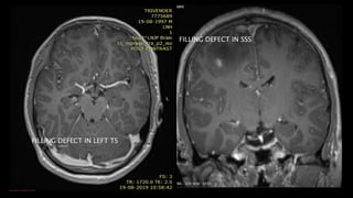 FILLING DEFECT IN SSS
FILLING DEFECT IN LEFT TS
 
