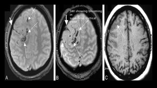 SWI showing blooming
in
superficial cortical
veins
 