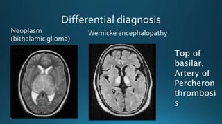 Top of
basilar,
Artery of
Percheron
thrombosi
s
 