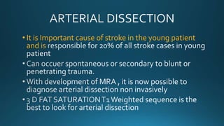 • It is Important cause of stroke in the young patient
and is
 