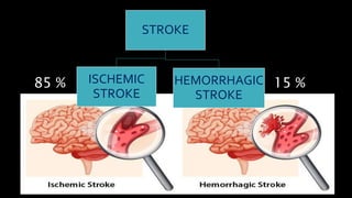 STROKE
HEMORRHAGIC
STROKE
ISCHEMIC
STROKE
85 % 15 %
 