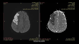 Head of right
caudate
nucleus and
lentiform
nucleus show
diffusion
restriction
 