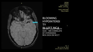 BLOOMING
HYPOINTENSI
TY
IN LEFT MCAARTERY SUSCEPTIBILTY
SIGN – MRI CORRELATE
OF HYPERDENSE
MCA SIGN ON NCCT
 
