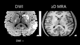 DWI +
DWI
HYPERINTENSI
TY
LOSS OF FLOW
IN LEFT MCA
 