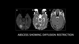 ABSCESS SHOWING DIFFUSION RESTRICTION
 