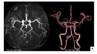 2D TOF MIP MRA 3D TOF VRT MRA
 