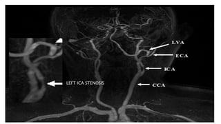 LEFT ICA STENOSIS
 