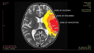 ZONE OF INFACRTION
ZONE OF PENUMBRA
ZONE OF OLIGEMIA
 