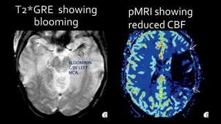 pMRI showing
reduced CBF
BLOOMININ
G IN LEFT
MCA
 