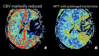 MTT with prolonged transit time
 