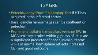 T2* GRE
•Petechial or gyriform “ blooming” foci
•Prominent ipsilateral medullary veins on SWI
 