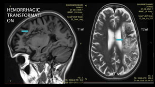 HEMORRHAGIC
TRANSFORMATI
ON
T1WI T2WI
 