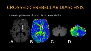 CROSSED CEREBELLAR DIASCHSIS
 