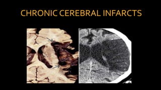CHRONIC CEREBRAL INFARCTS
 