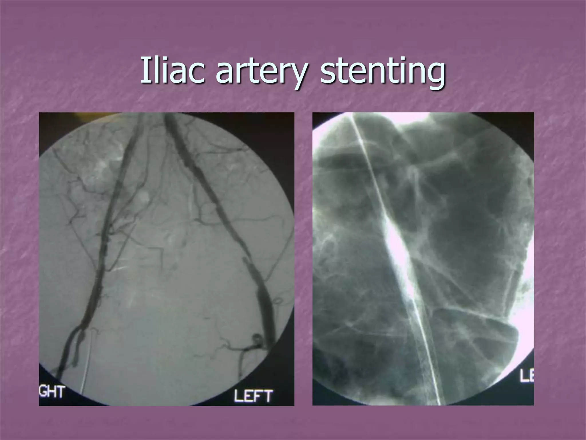 Stenting Iih Introduction to Interventional Radiology.pptx