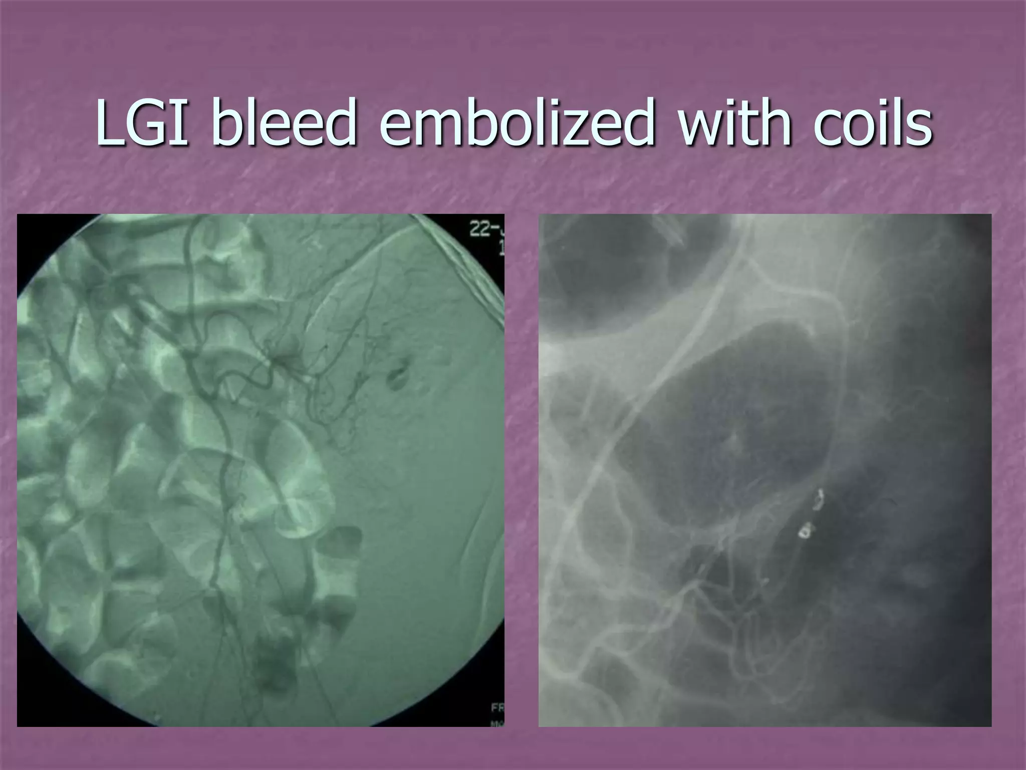Rgi Injection Introduction to Interventional Radiology.pptx