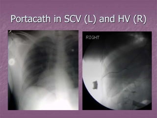 Introduction to Interventional Radiology.pptx