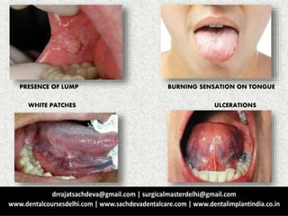PRESENCE OF LUMP BURNING SENSATION ON TONGUE
WHITE PATCHES ULCERATIONS
 