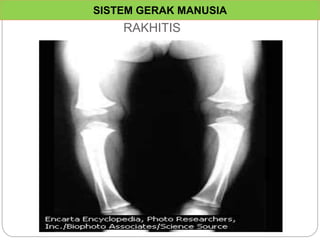 Kaki Rakhitis PPT 3.1 Sistem Gerak Manusia 1 aaaaaaaaaaaa | PPTX