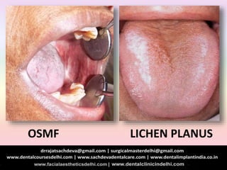 OSMF LICHEN PLANUS
 