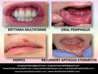HERPES RECURRENT APTHOUS STOMATITIS
ERYTHMA MULTIFORME ORAL PEMPHIGUS
 