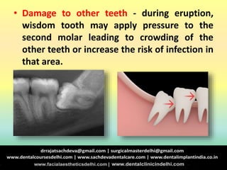 • Damage to other teeth - during eruption,
wisdom tooth may apply pressure to the
second molar leading to crowding of the
other teeth or increase the risk of infection in
that area.
 