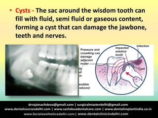 • Cysts - The sac around the wisdom tooth can
fill with fluid, semi fluid or gaseous content,
forming a cyst that can damage the jawbone,
teeth and nerves.
 